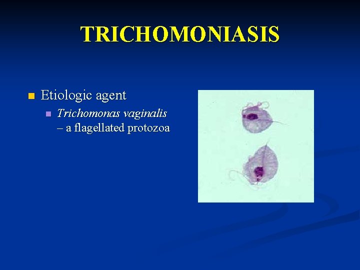 TRICHOMONIASIS n Etiologic agent n Trichomonas vaginalis – a flagellated protozoa 