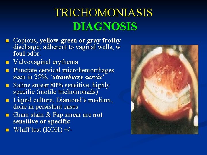 TRICHOMONIASIS DIAGNOSIS n n n n Copious, yellow-green or gray frothy discharge, adherent to