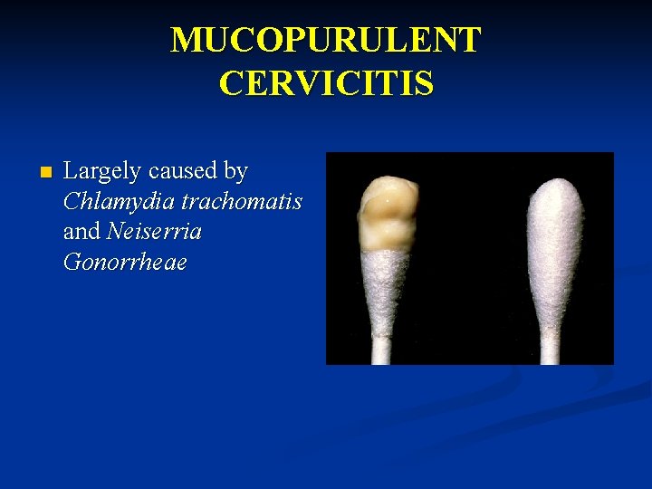 MUCOPURULENT CERVICITIS n Largely caused by Chlamydia trachomatis and Neiserria Gonorrheae 