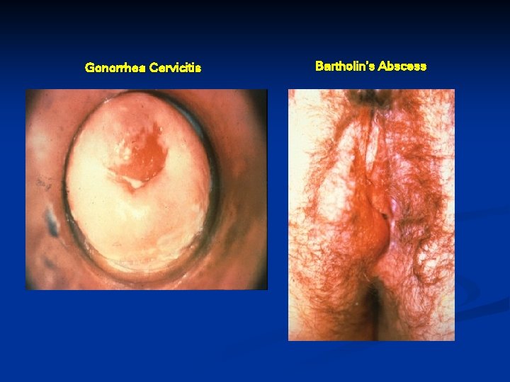 Gonorrhea Cervicitis Bartholin’s Abscess 