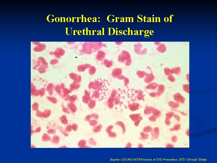 Gonorrhea: Gram Stain of Urethral Discharge Source: CDC/NCHSTP/Division of STD Prevention, STD Clinical Slides