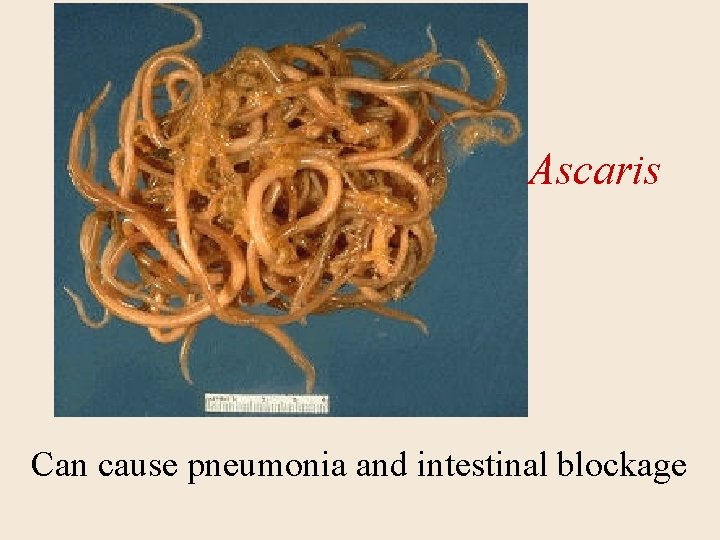 Ascaris Can cause pneumonia and intestinal blockage 