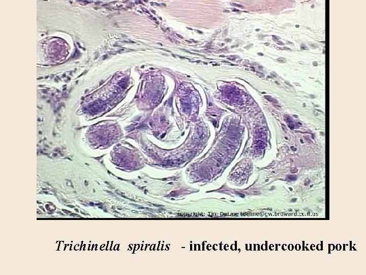 Trichinella spiralis - infected, undercooked pork 