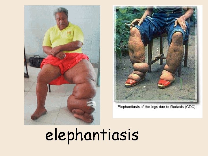 elephantiasis 