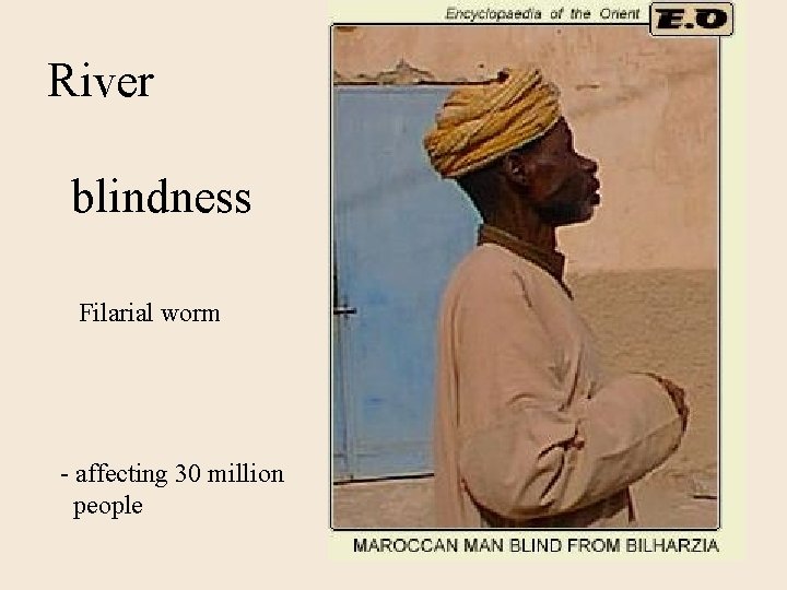 River blindness Filarial worm - affecting 30 million people 
