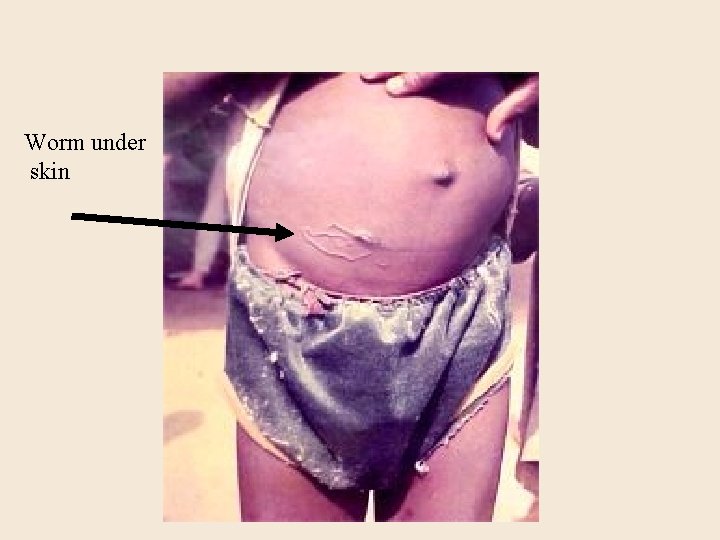Worm under skin 