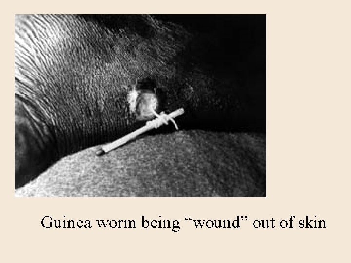 Guinea worm being “wound” out of skin 