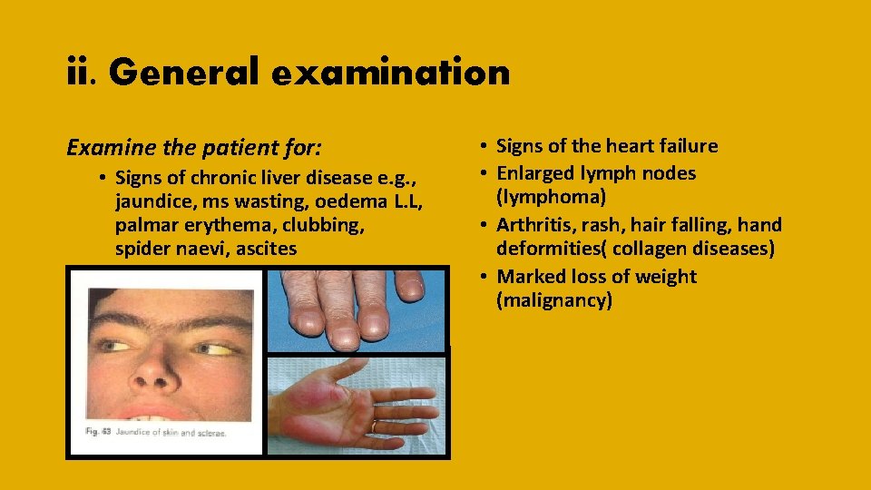 ii. General examination Examine the patient for: • Signs of chronic liver disease e.