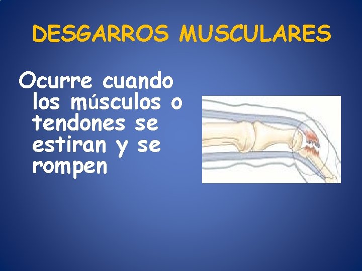 DESGARROS MUSCULARES Ocurre cuando los músculos o tendones se estiran y se rompen 