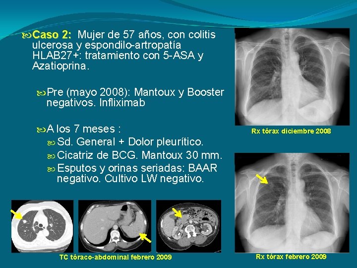  Caso 2: Mujer de 57 años, con colitis ulcerosa y espondilo-artropatía HLAB 27+: