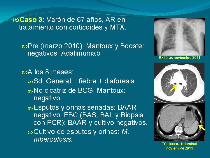  Caso 3: Varón de 67 años, AR en tratamiento con corticoides y MTX.