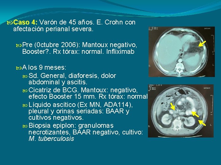  Caso 4: Varón de 45 años. E. Crohn con afectación perianal severa. Pre