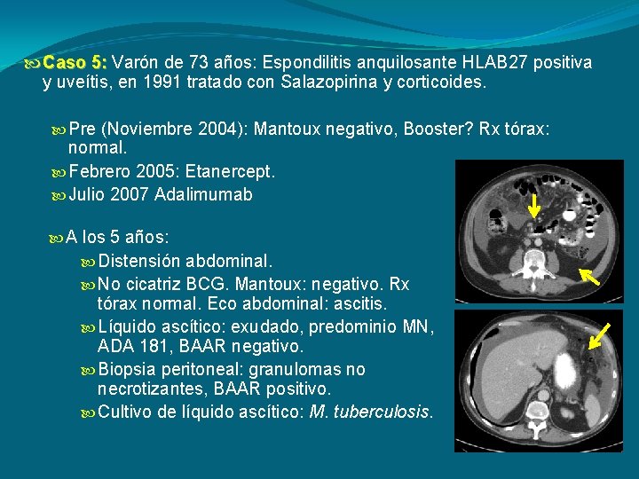  Caso 5: Varón de 73 años: Espondilitis anquilosante HLAB 27 positiva y uveítis,