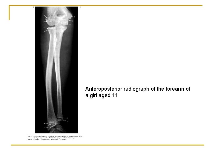 Anteroposterior radiograph of the forearm of a girl aged 11 