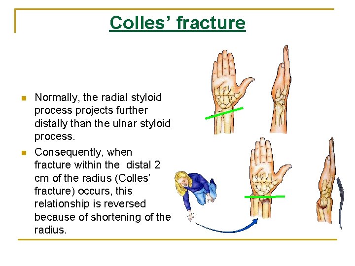 Colles’ fracture n n Normally, the radial styloid process projects further distally than the