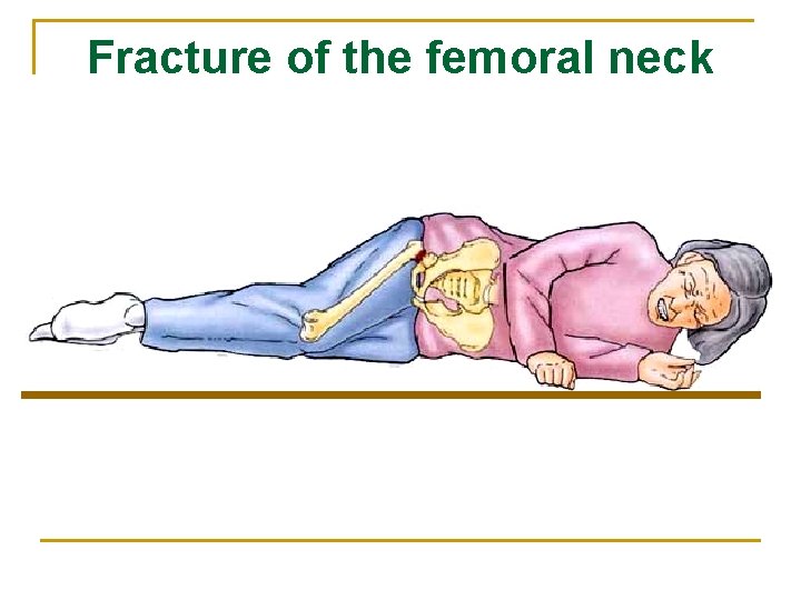 Fracture of the femoral neck 