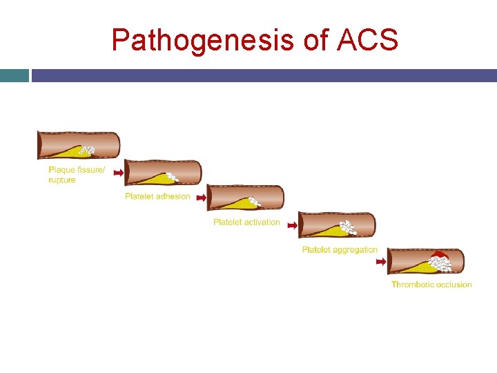 Pathogenesis of ACS 