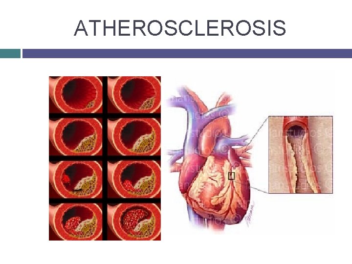 ATHEROSCLEROSIS 