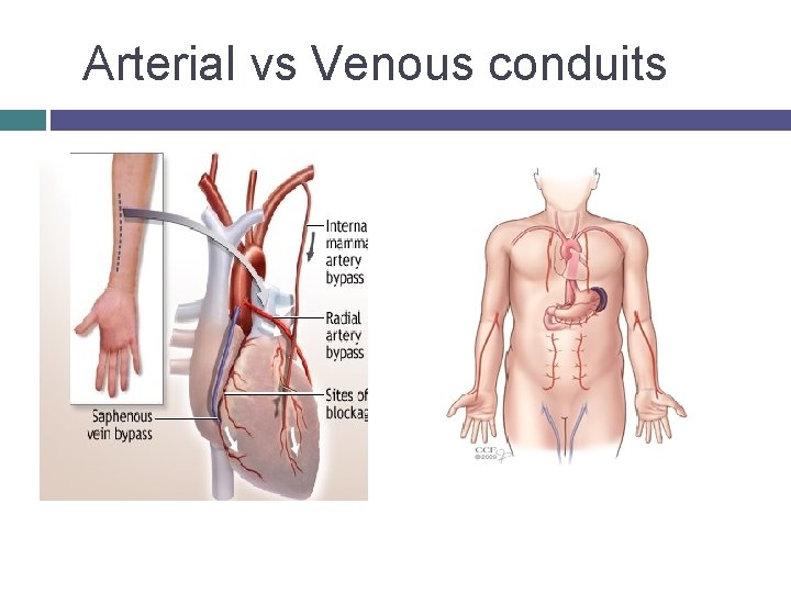 Arterial vs Venous conduits 