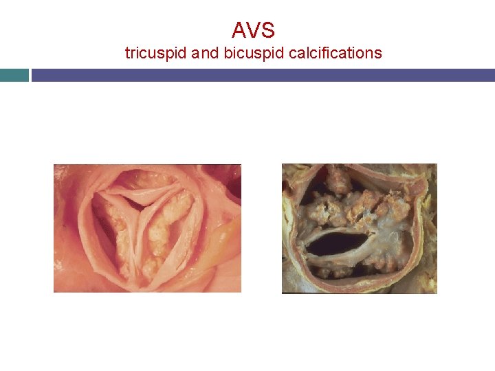 AVS tricuspid and bicuspid calcifications 