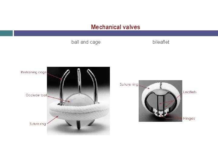 Mechanical valves ball and cage bileaflet 