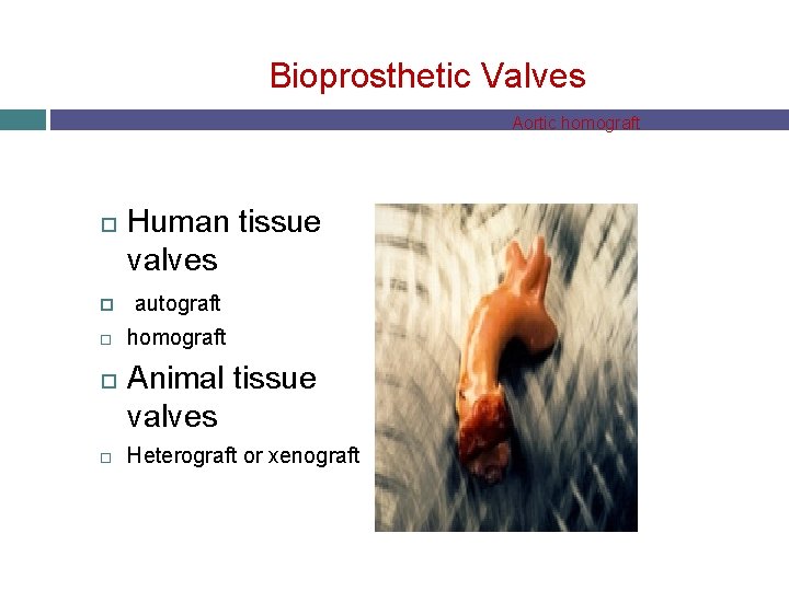 Bioprosthetic Valves Aortic homograft Human tissue valves autograft homograft Animal tissue valves Heterograft or