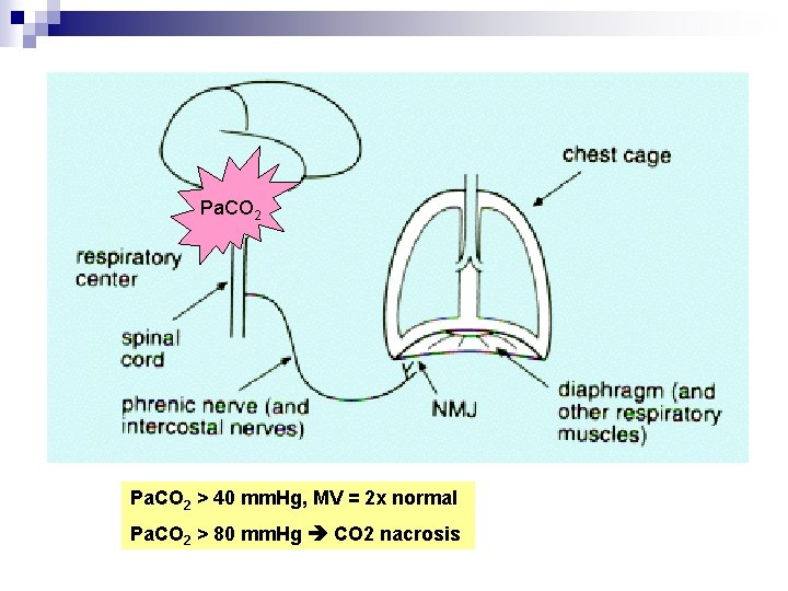Pa. CO 2 > 40 mm. Hg, MV = 2 x normal Pa. CO Pa. CO 2 > 40 mm. Hg, MV = 2 x normal Pa. CO