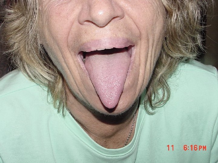 Tongue and Frenulum 