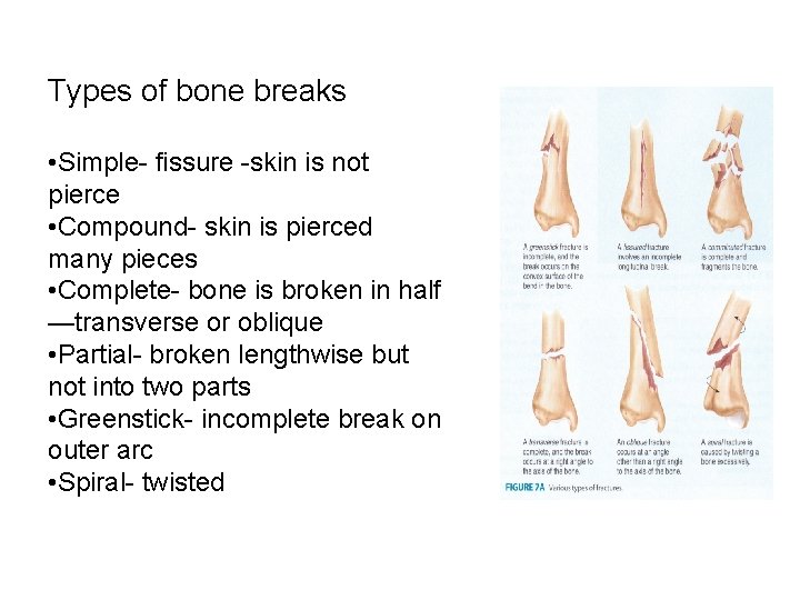 Types of bone breaks • Simple- fissure -skin is not pierce • Compound- skin