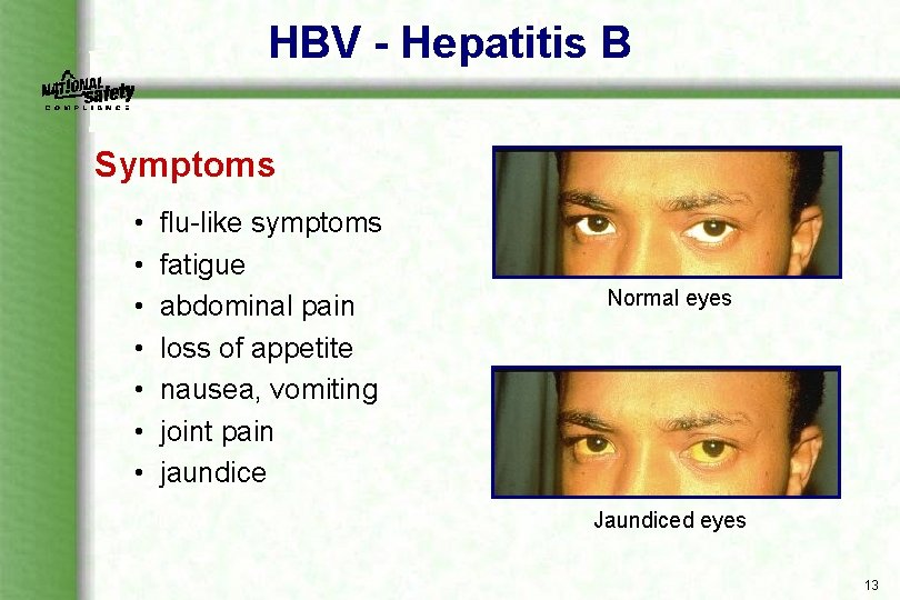 HBV - Hepatitis B Symptoms • • flu like symptoms fatigue abdominal pain loss