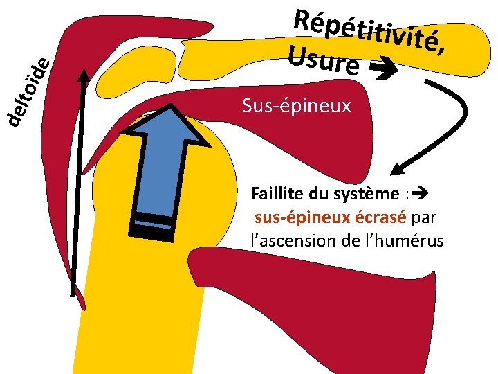 toï de del Répétiti vité, Usure Sus-épineux Faillite du système : sus-épineux écrasé par