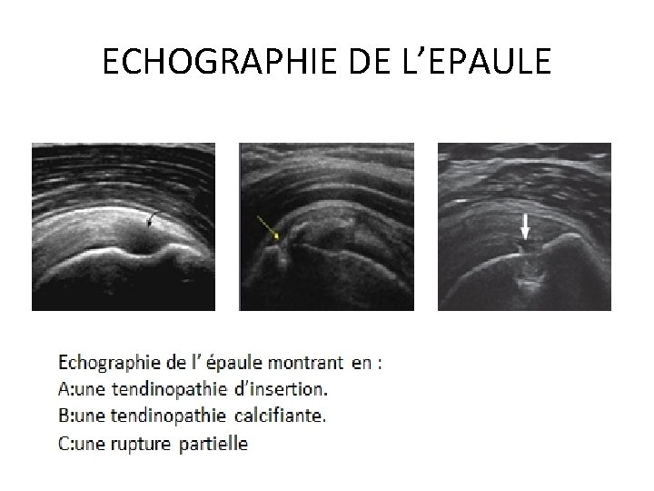 ECHOGRAPHIE DE L’EPAULE 