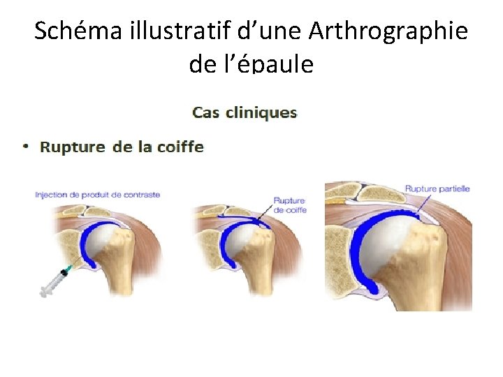 Schéma illustratif d’une Arthrographie de l’épaule 