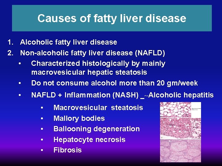 Causes of fatty liver disease 1. Alcoholic fatty liver disease 2. Non-alcoholic fatty liver