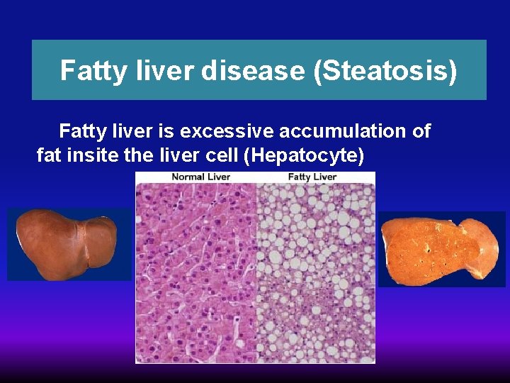 Fatty liver disease (Steatosis) Fatty liver is excessive accumulation of fat insite the liver