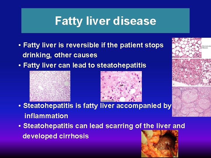 Fatty liver disease • Fatty liver is reversible if the patient stops drinking, other