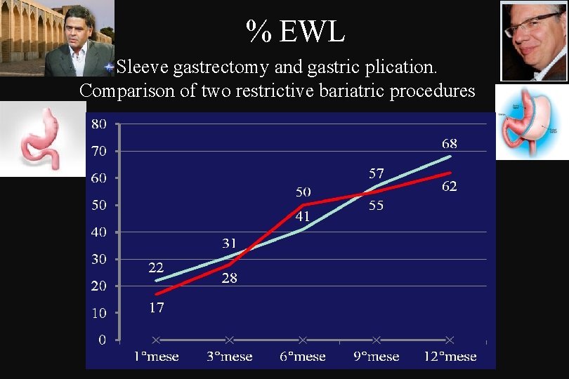 % EWL Sleeve gastrectomy and gastric plication. Comparison of two restrictive bariatric procedures 