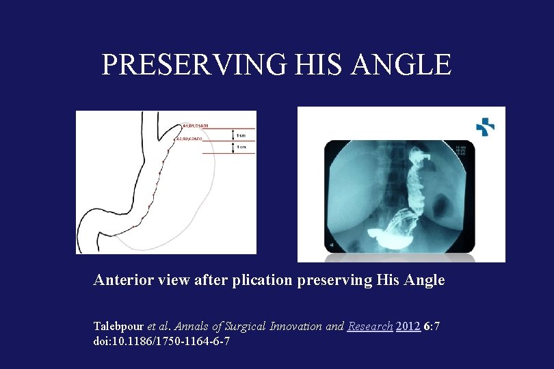 PRESERVING HIS ANGLE Anterior view after plication preserving His Angle Talebpour et al. Annals