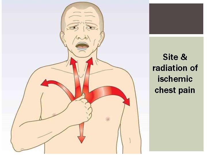 Site & radiation of ischemic chest pain 