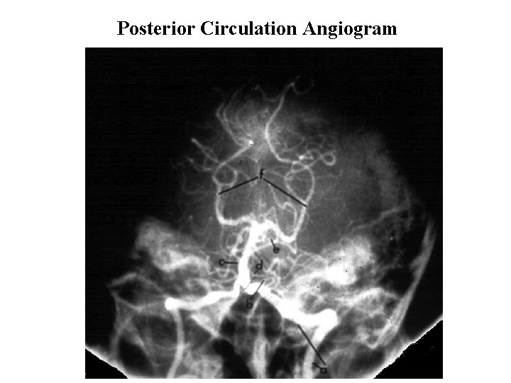 Posterior Circulation Angiogram 