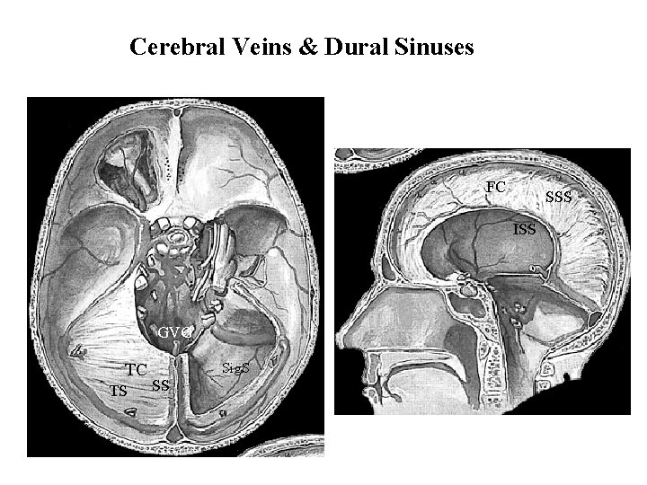 Cerebral Veins & Dural Sinuses FC SSS ISS GVG TC TS Sig. S SS