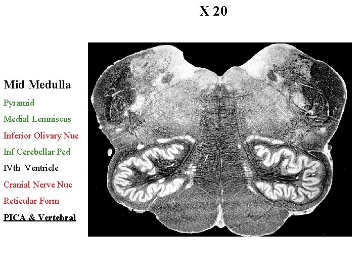 X 20 Mid Medulla Pyramid Medial Lemniscus Inferior Olivary Nuc Inf Cerebellar Ped IVth