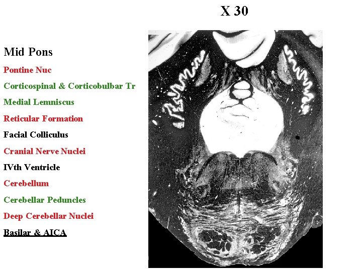 X 30 Mid Pons Pontine Nuc Corticospinal & Corticobulbar Tr Medial Lemniscus Reticular Formation