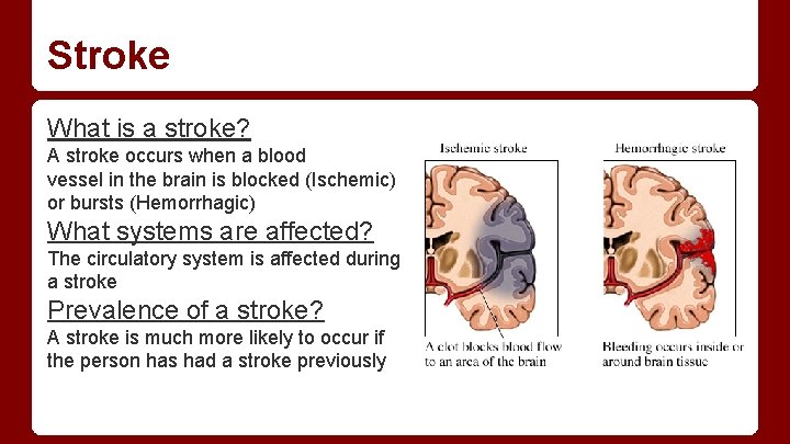 Stroke What is a stroke? A stroke occurs when a blood vessel in the