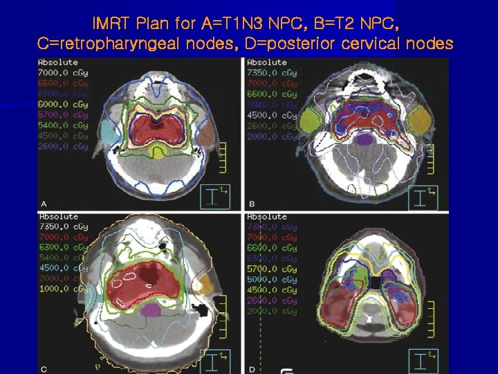 IMRT Plan for A=T 1 N 3 NPC, B=T 2 NPC, C=retropharyngeal nodes, D=posterior