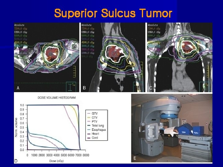 Superior Sulcus Tumor 