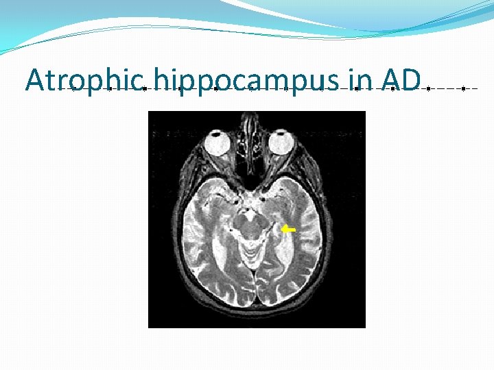 Atrophic hippocampus in AD 