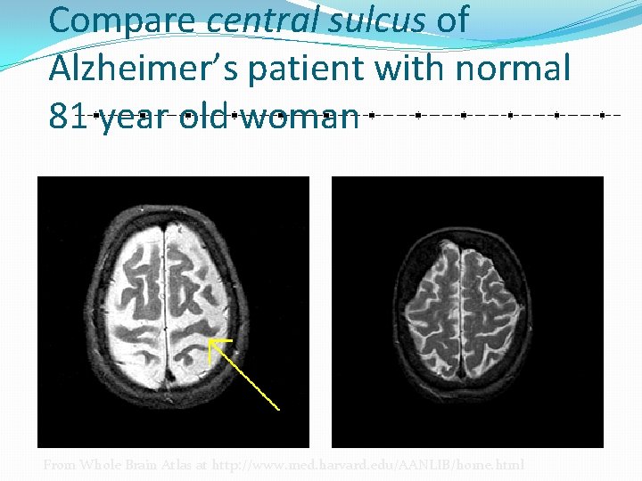 Compare central sulcus of Alzheimer’s patient with normal 81 year old woman From Whole