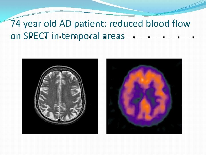 74 year old AD patient: reduced blood flow on SPECT in temporal areas 