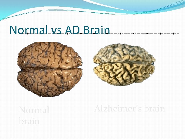 Normal vs AD Brain Normal brain Alzheimer’s brain 